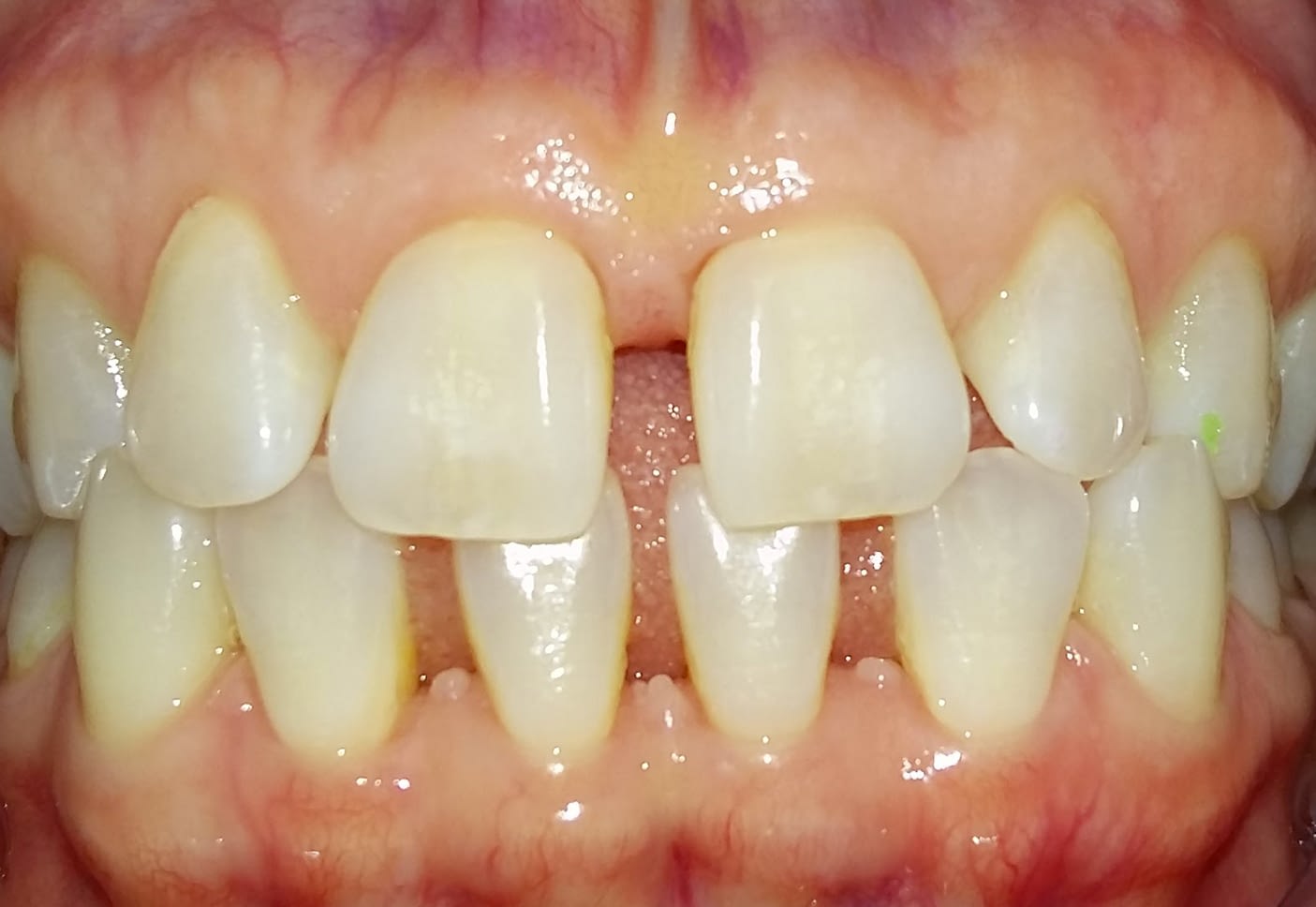 Invisalign Before Treatment Cardiff