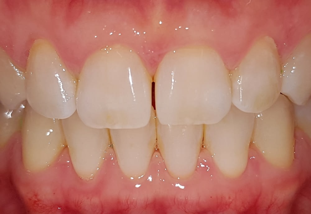 Invisalign After Treatment Cardiff