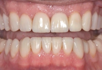 After Veneers 2