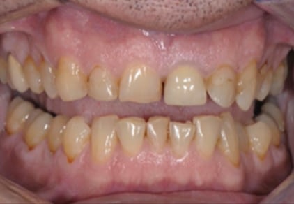 Before Veneers 2