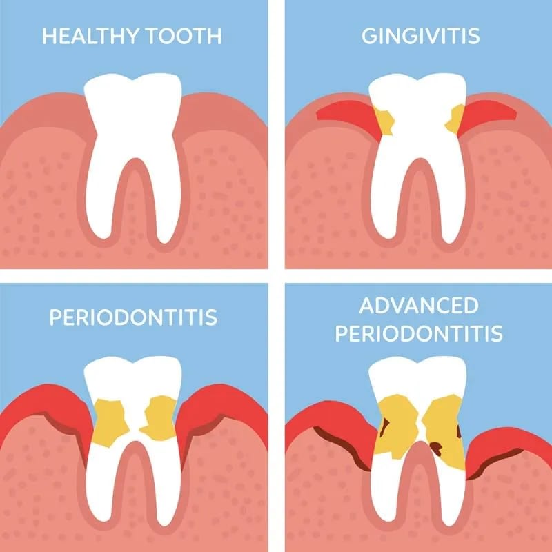 "periodontal
