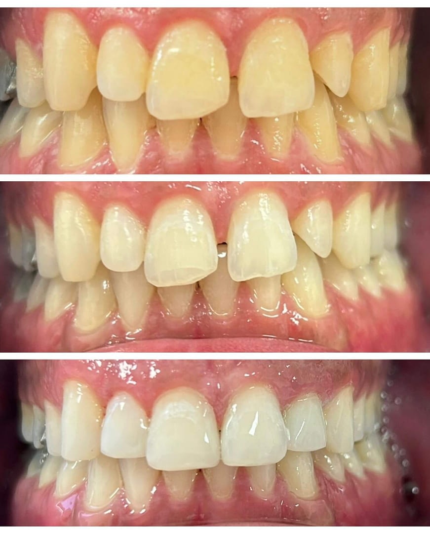 ep before and after