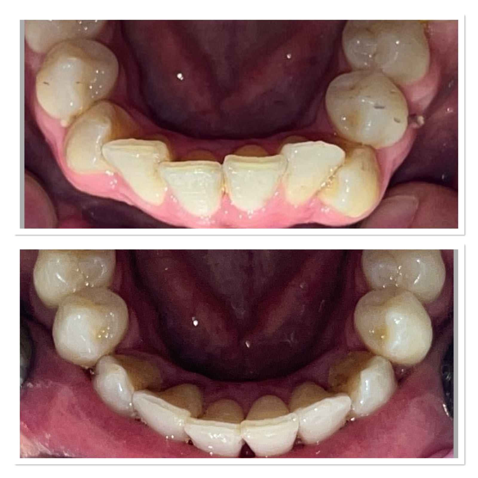 Invisalign before and after, lower teeth, by Dr Rebecca Dixon