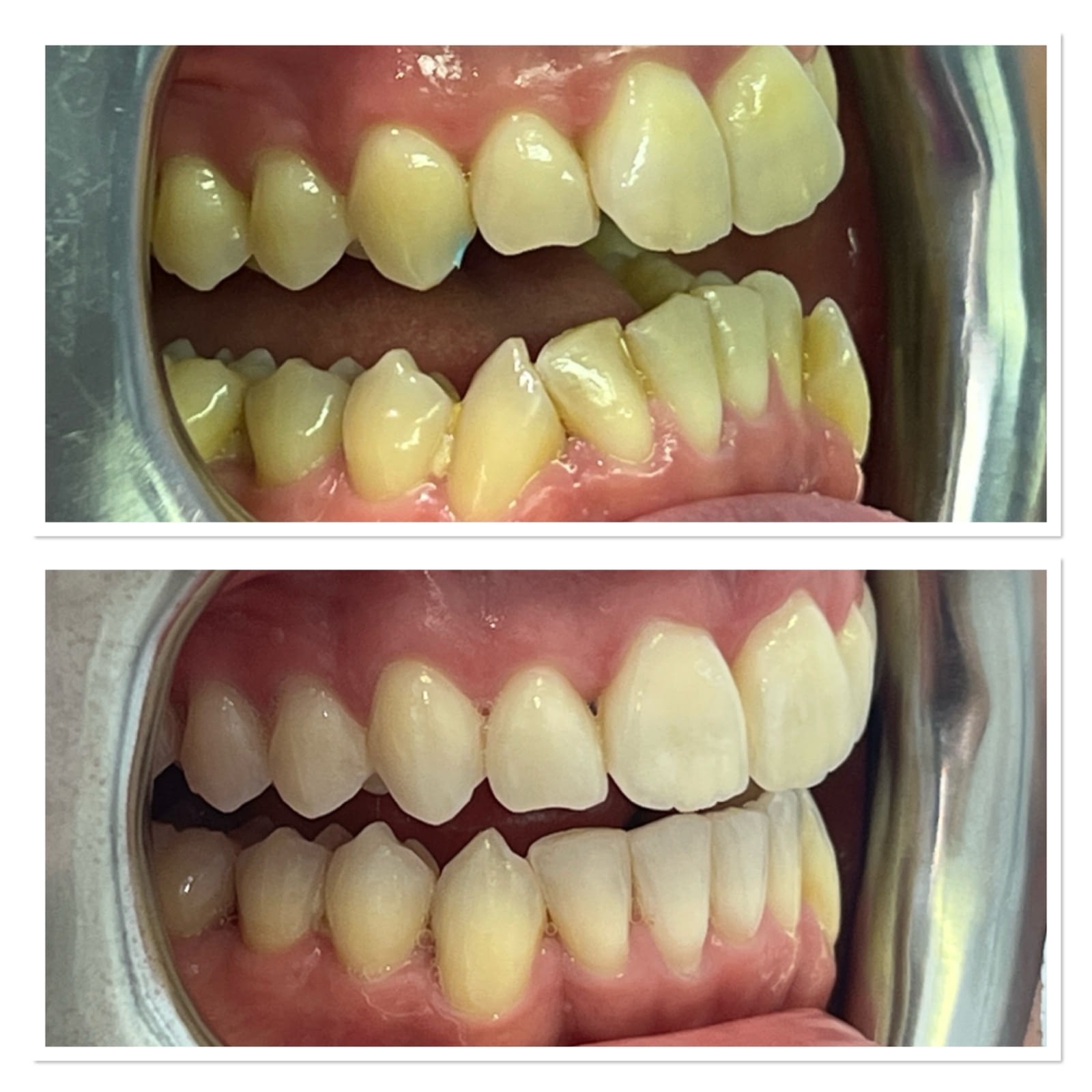 Invisalign before and after, side view, by Dr Rebecca Dixon