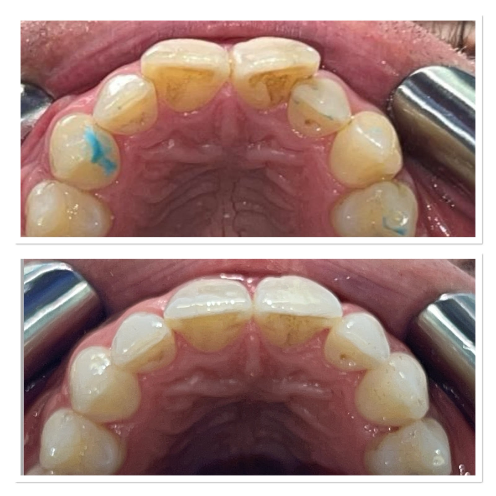 Invisalign before and after, upper teeth, by Dr Rebecca Dixon