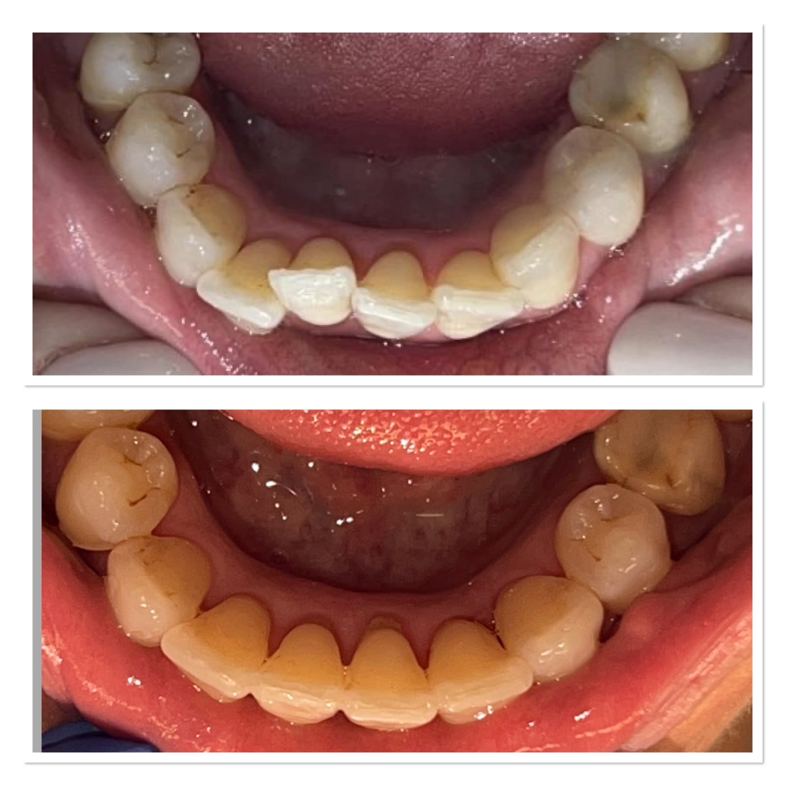 Invisalign before and after, lower teeth, by Dr Rebecca Dixon