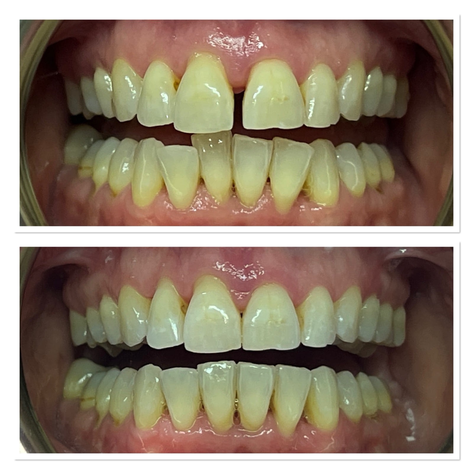 Invisalign before and after, front view, by Dr Rebecca Dixon