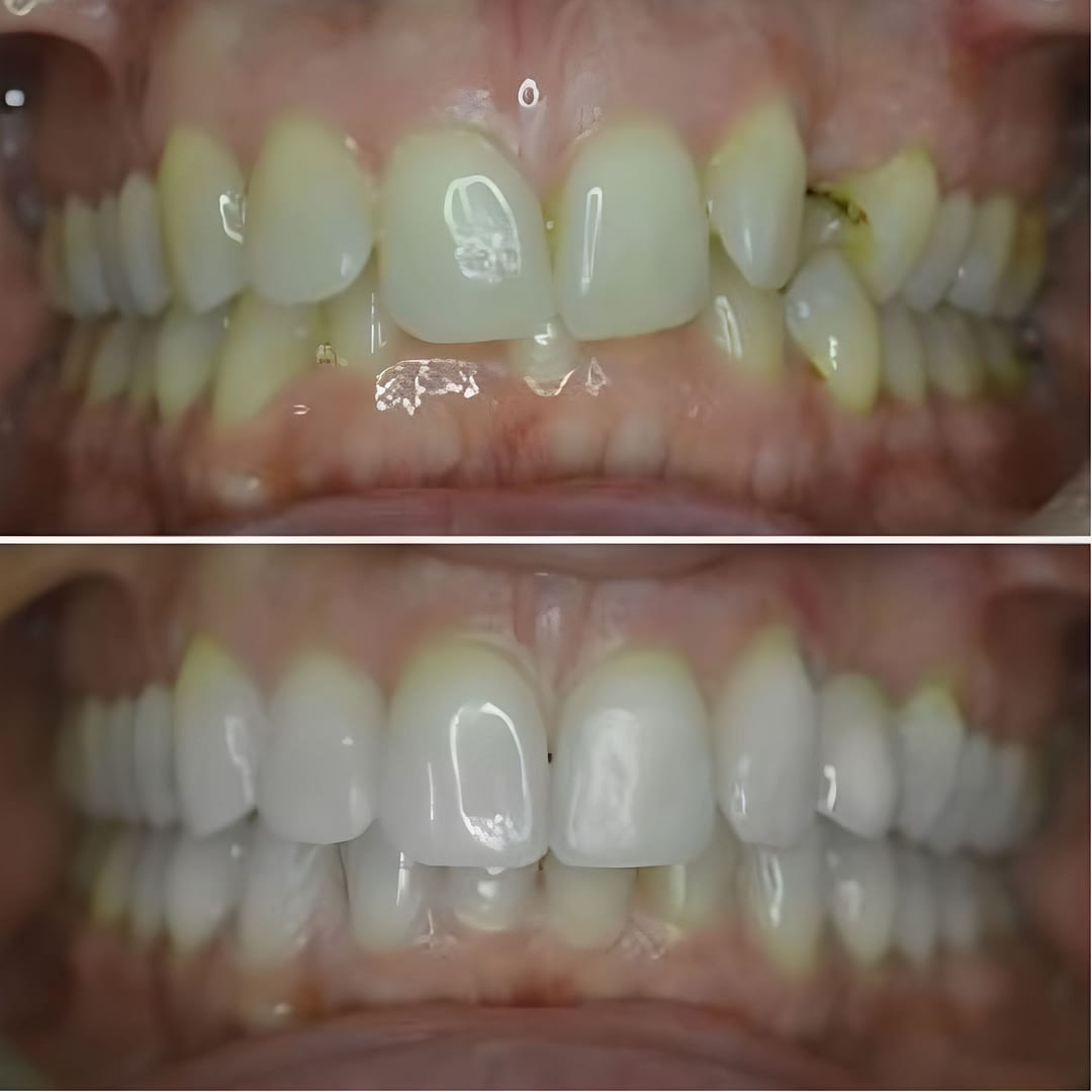 lingual braces before after img