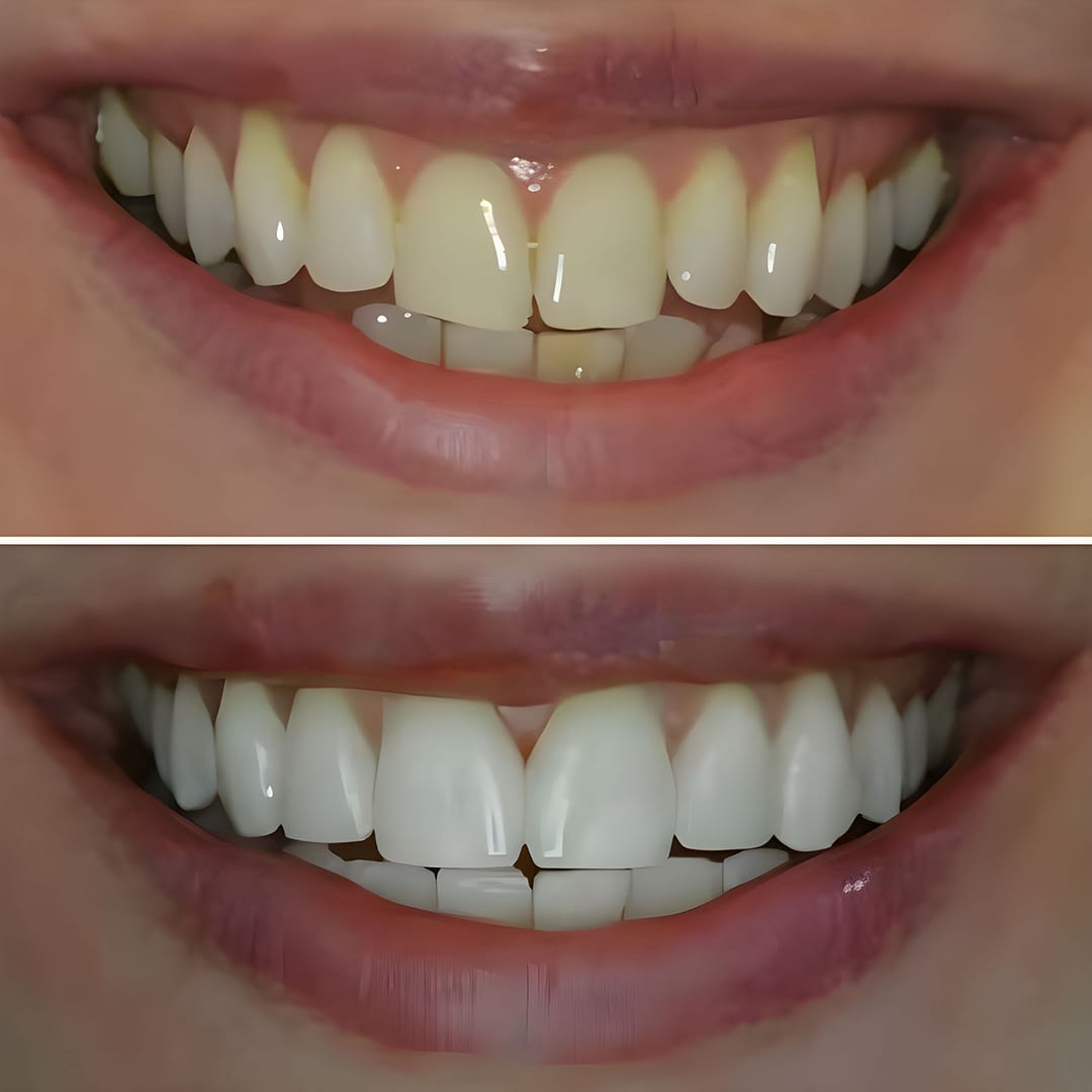 orthodontics before after image