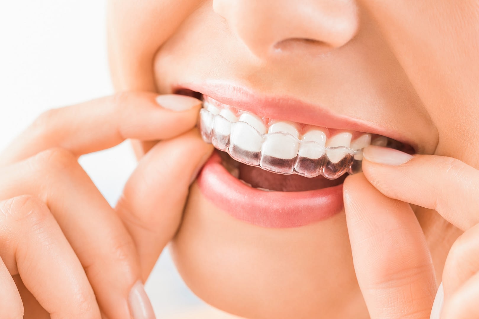 Smile Studio Invisalign Penarth