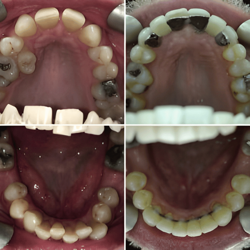 lingual braces treatment before after image