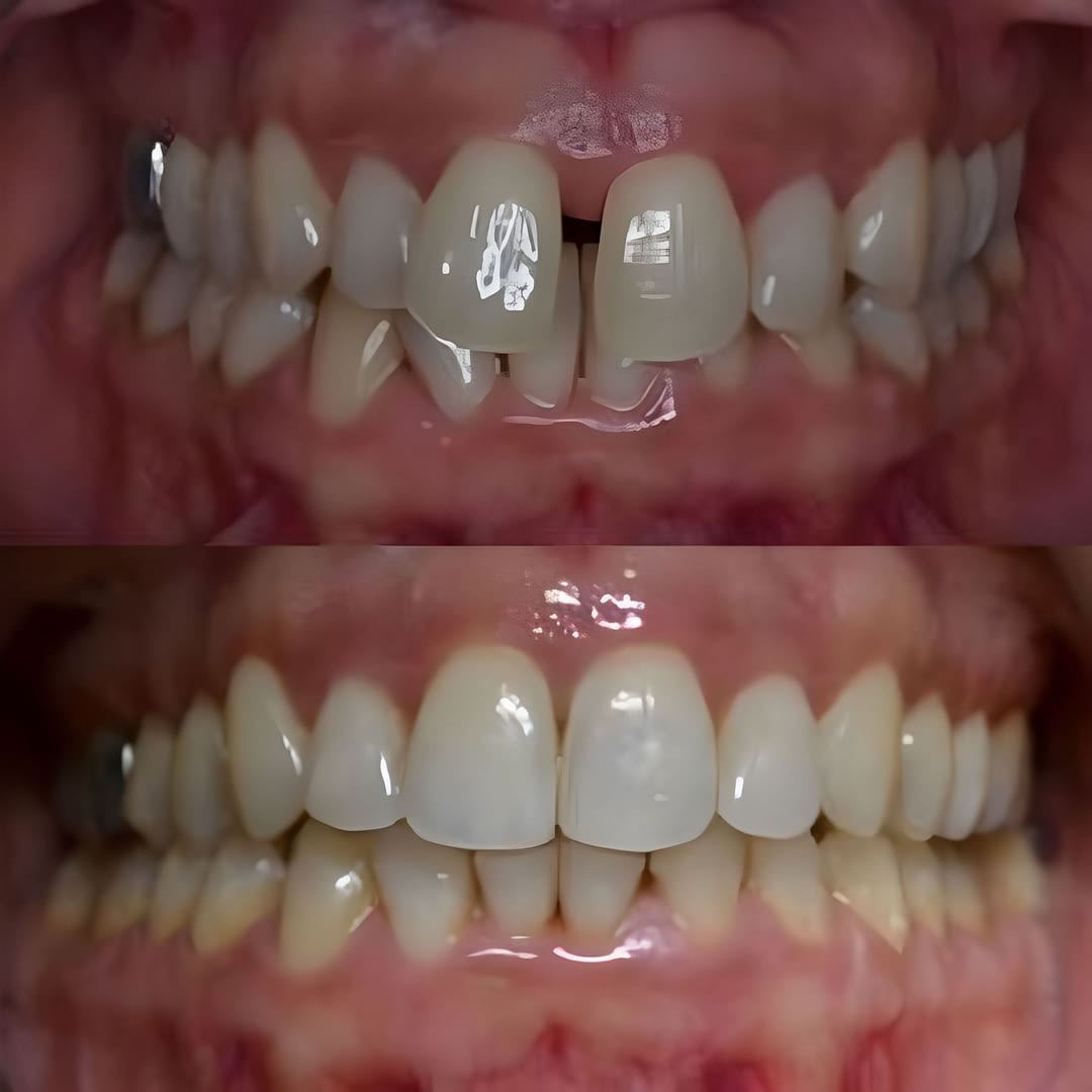 fixed braces before after img fixed braces before after img