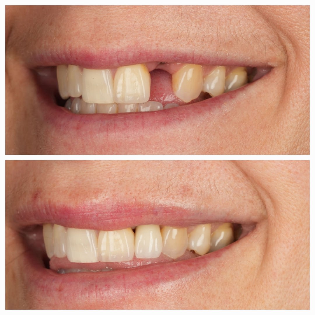 implant before and after