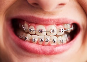 shot-child-s-teeth-with-braces-300x215.jpg