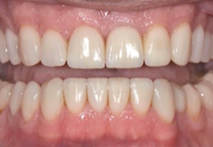 After Veneers 2