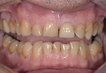 Before Veneers 2