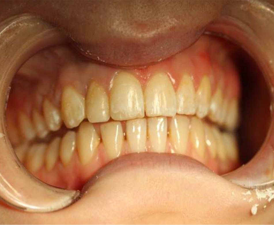 Fixed Upper Arch Othodontics Penarth After