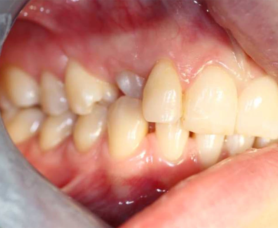 Fixed Upper Arch Othodontics Penarth Before