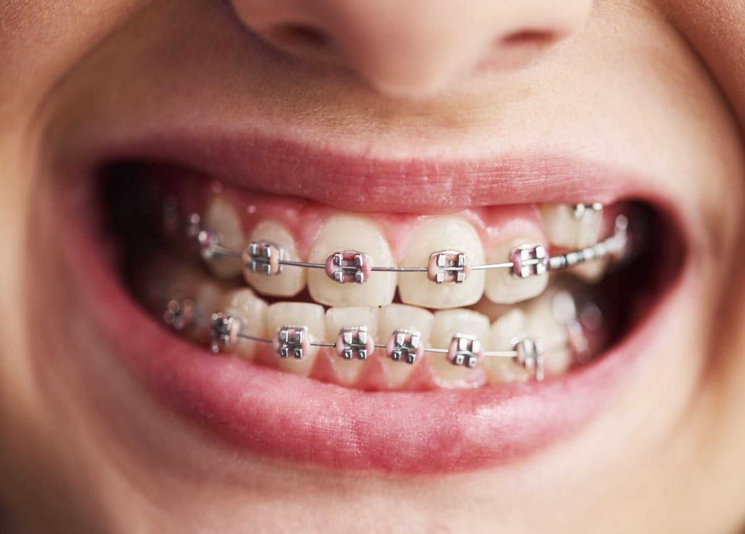 Fixed Braces