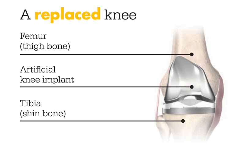 Robot Knee Replacement Surgery Wales - All you need know